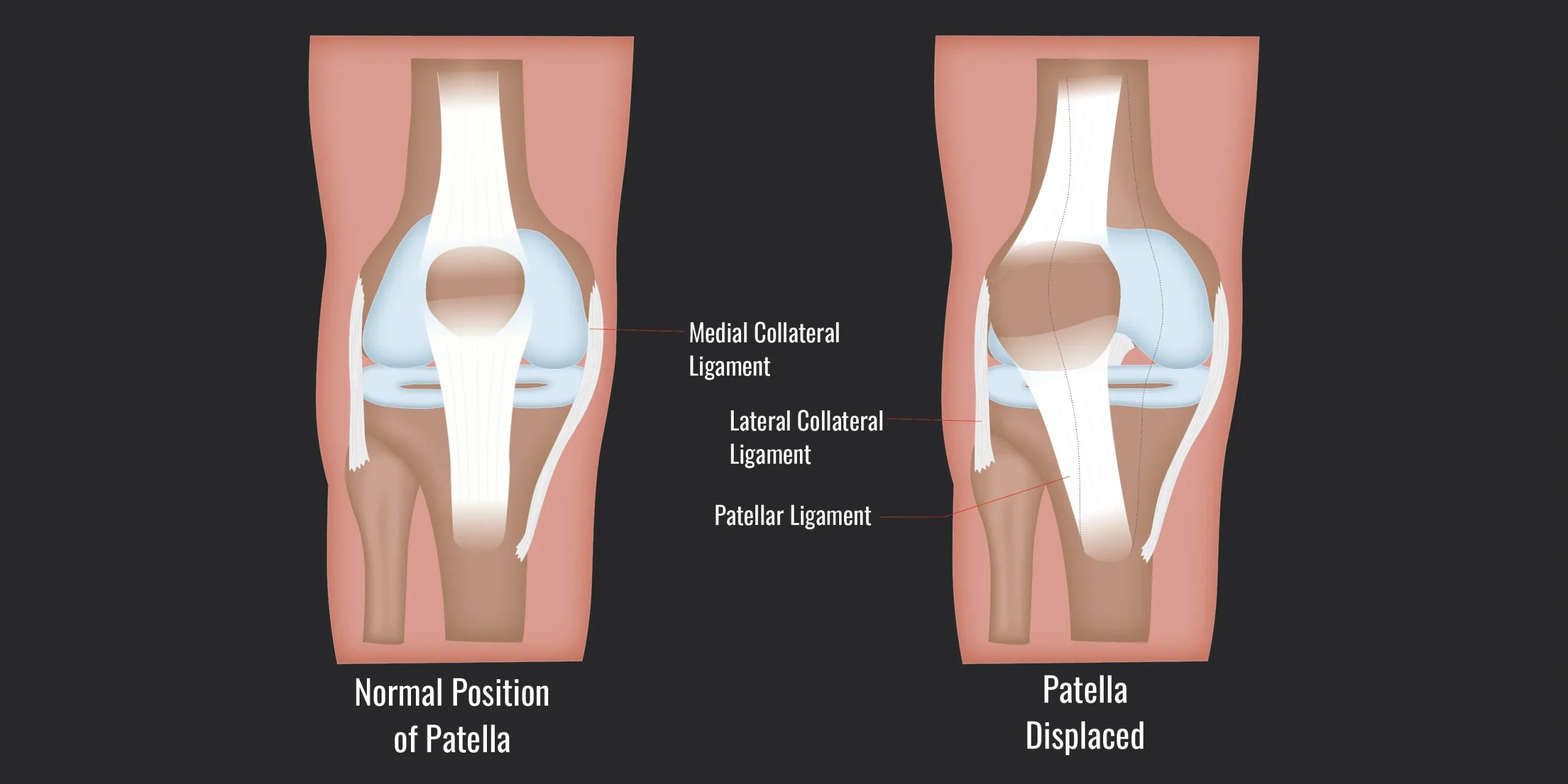 Diagram comparing the normal position of the patella with a displaced patella, with the medial collateral, lateral collateral, and patellar ligaments labeled